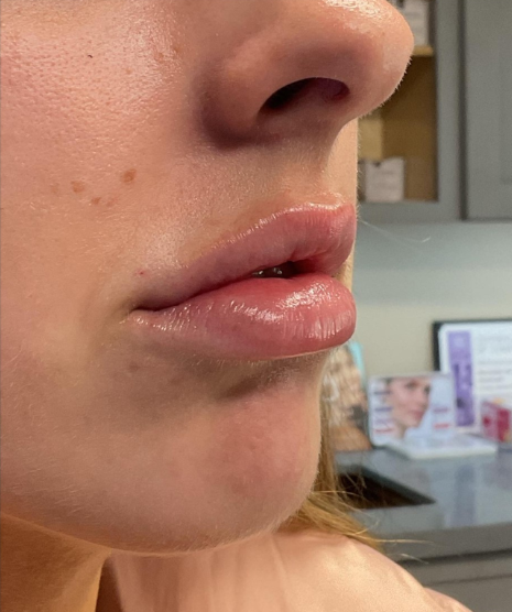 Dermal Fillers Case 53 After Image