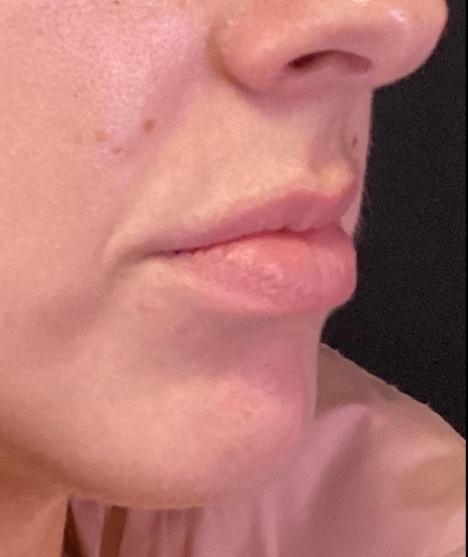 Dermal Fillers Case 53 Before Image