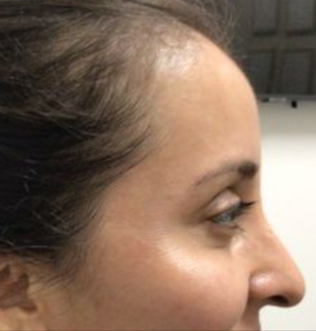 Botox® / Dysport® Case 25 After Image