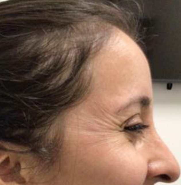 Botox® / Dysport® Case 25 Before Image