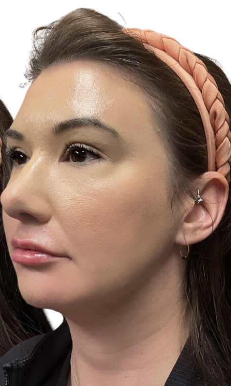 Dermal Fillers Case 55 After Image