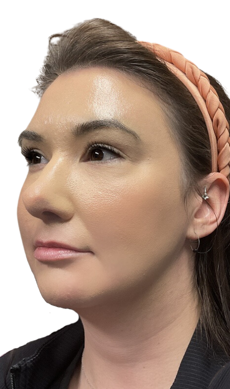 Dermal Fillers Case 55 Before Image