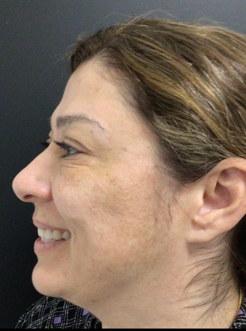 Botox® / Dysport® Case 26 After Image
