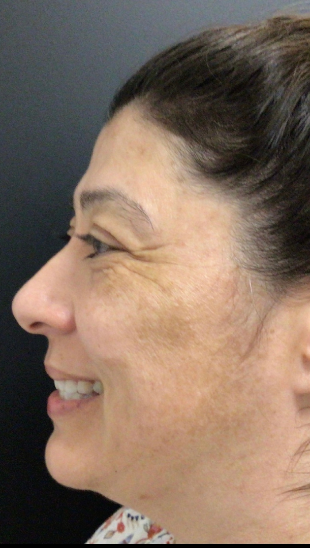 Botox® / Dysport® Case 26 Before Image
