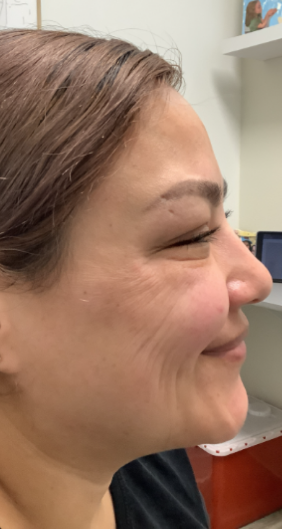 Botox® / Dysport® Case 27 After Image