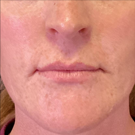 Dermal Fillers Case 51 Before Image