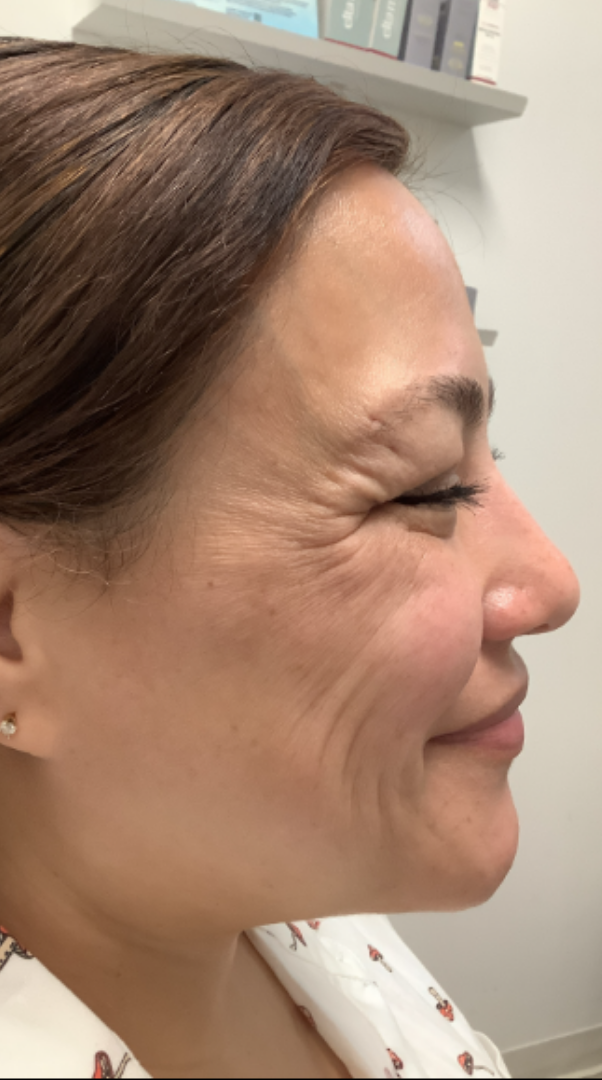 Botox® / Dysport® Case 27 Before Image