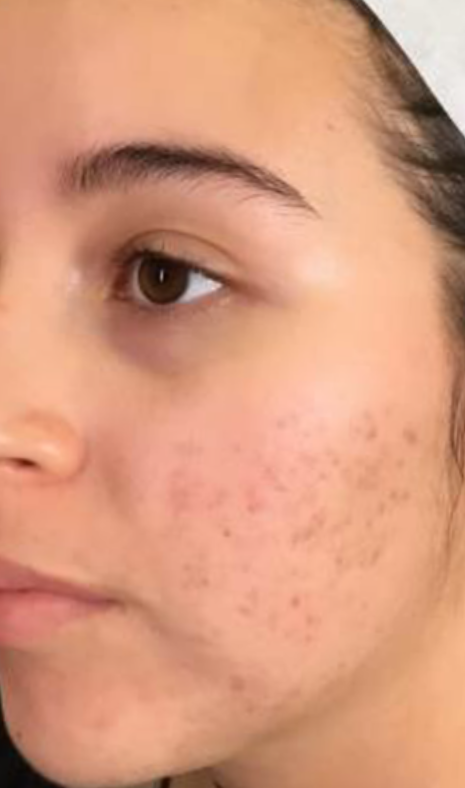 Microneedling Case 4 After Image