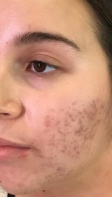 Microneedling Case 4 Before Image