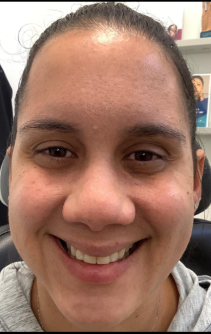Botox® / Dysport® Case 28 After Image