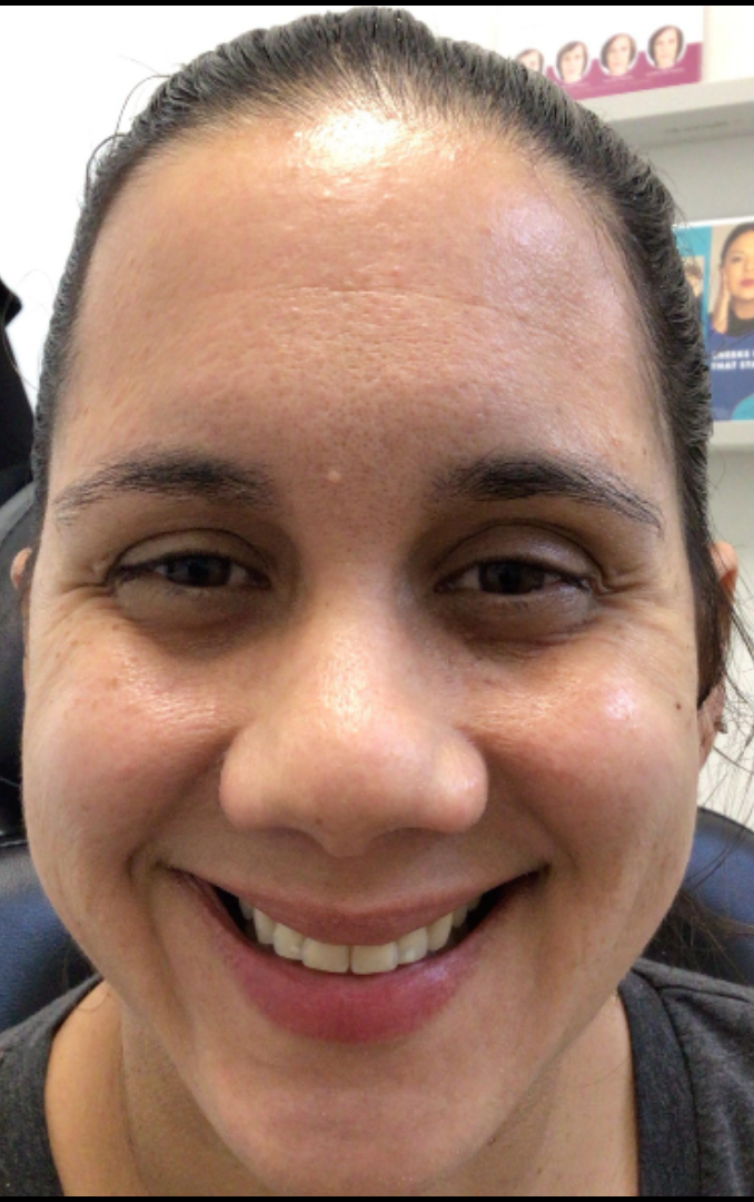 Botox® / Dysport® Case 28 Before Image
