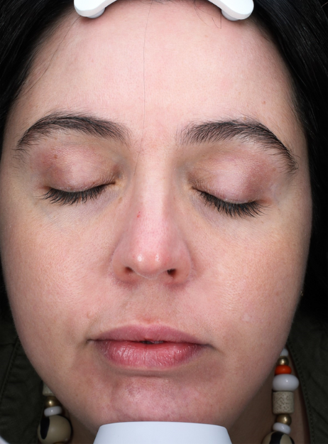 BBL Therapy Case 7 After Image