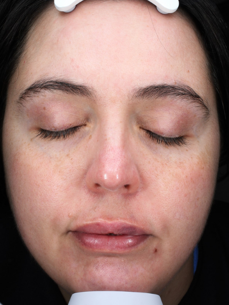 BBL Therapy Case 7 Before Image