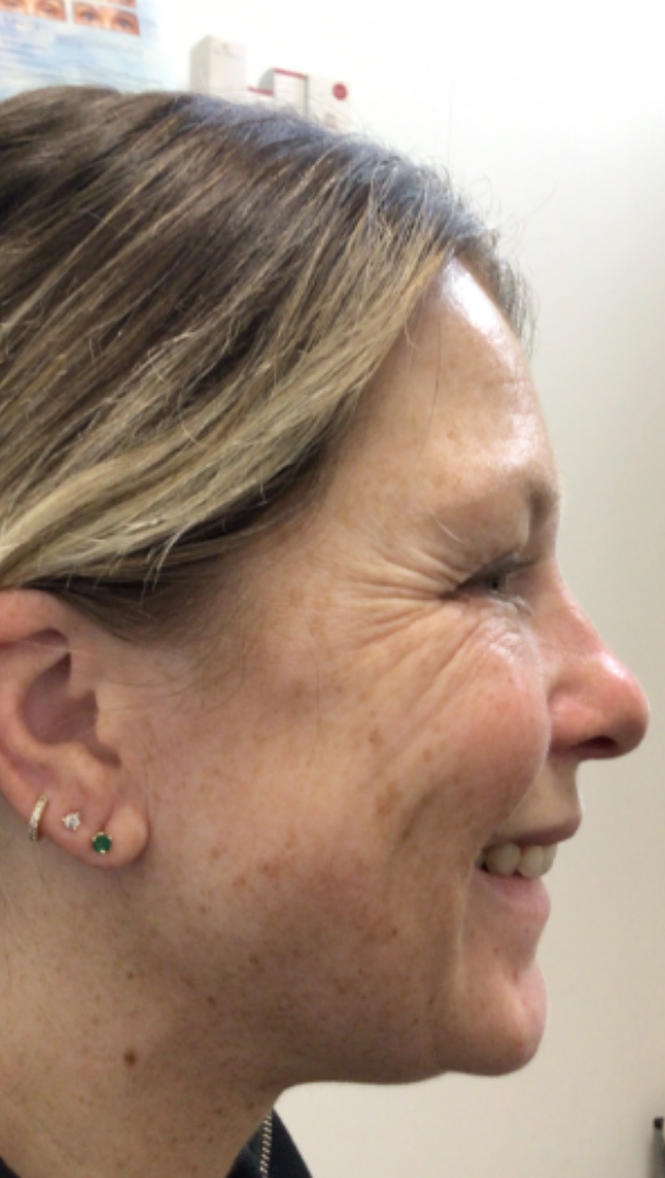 Botox® / Dysport® Case 29 Before Image
