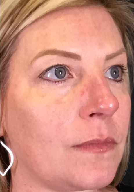 BBL Therapy Case 8 After Image