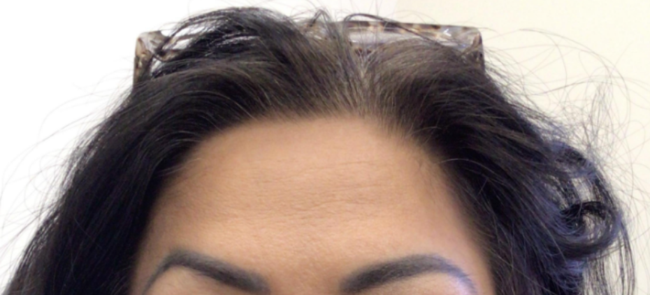 Botox® / Dysport® Case 30 After Image