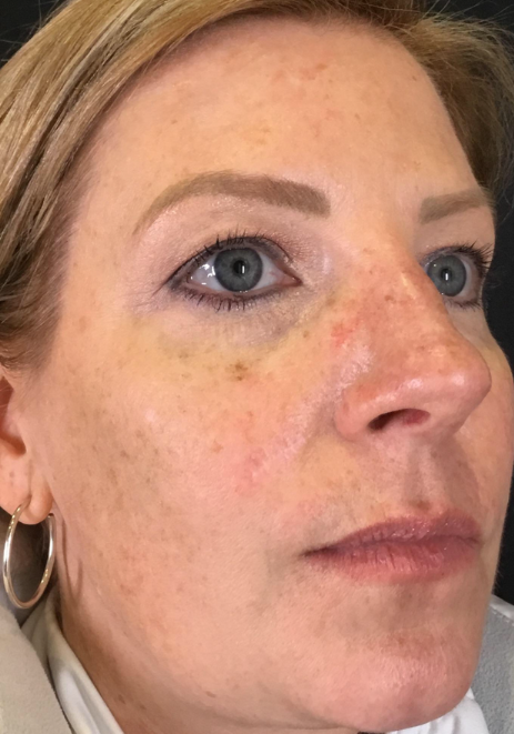 BBL Therapy Case 8 Before Image