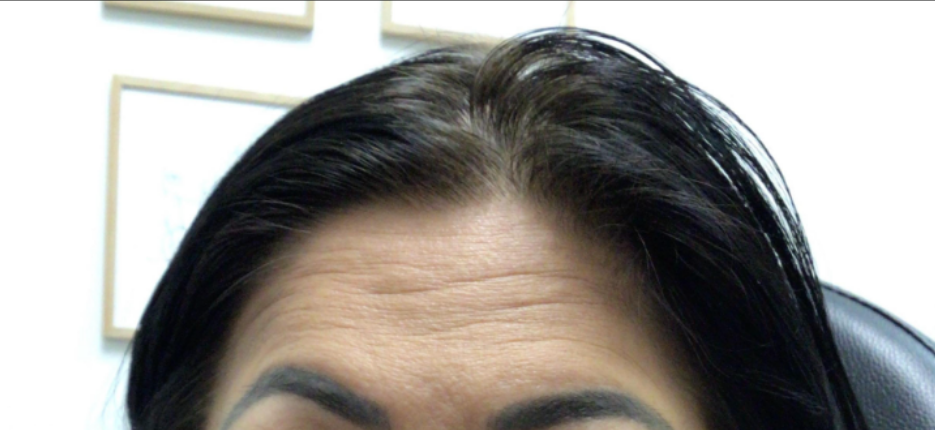 Botox® / Dysport® Case 30 Before Image
