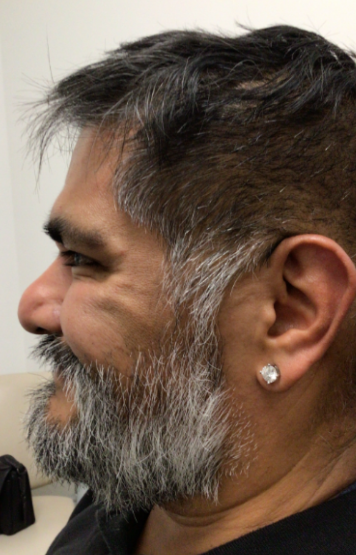 Botox® / Dysport® Case 31 Before Image