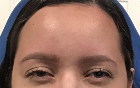 Botox® / Dysport® Case 16 After Image