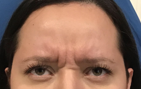 Botox® / Dysport® Case 16 Before Image