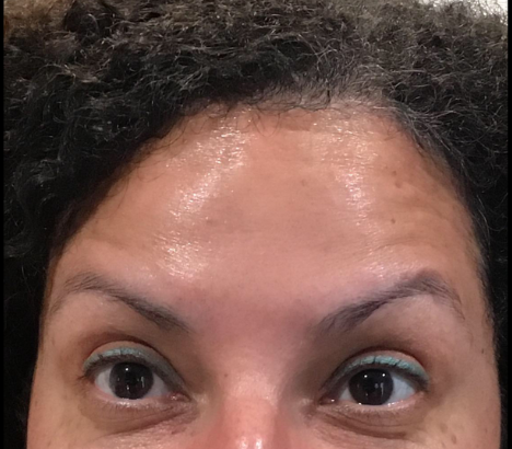 Botox® / Dysport® Case 22 After Image