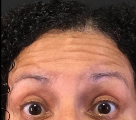 Botox® / Dysport® Case 22 Before Image