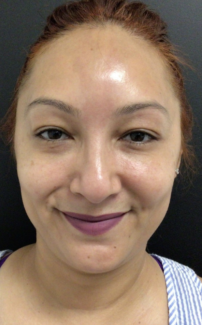Botox® / Dysport® Case 32 After Image