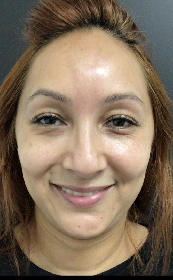 Botox® / Dysport® Case 32 Before Image