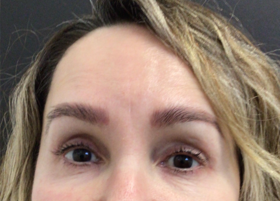 Botox® / Dysport® Case 33 After Image