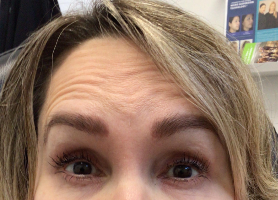Botox® / Dysport® Case 33 Before Image
