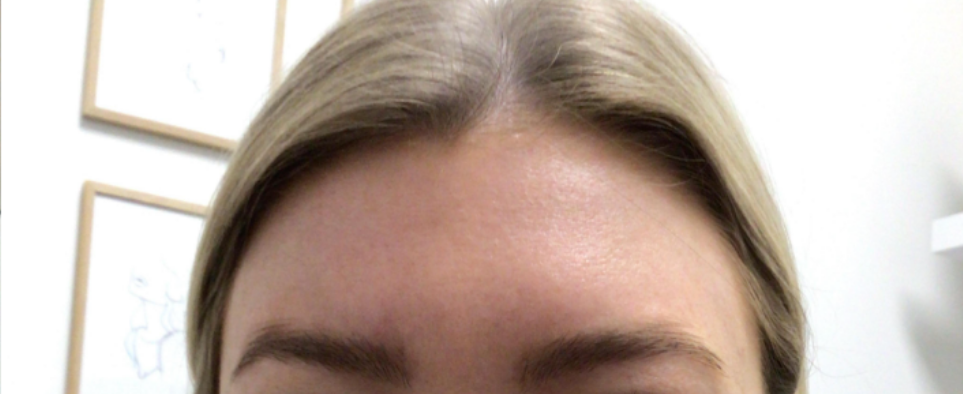 Botox® / Dysport® Case 34 After Image