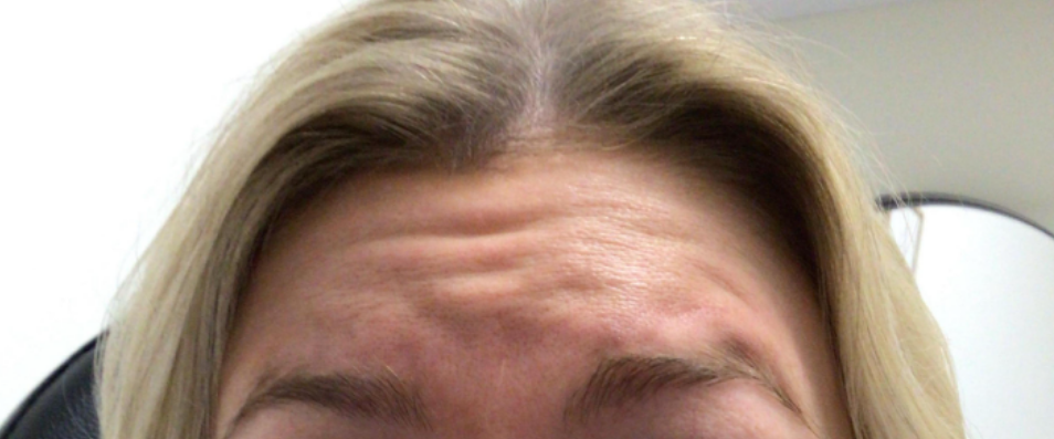 Botox® / Dysport® Case 34 Before Image
