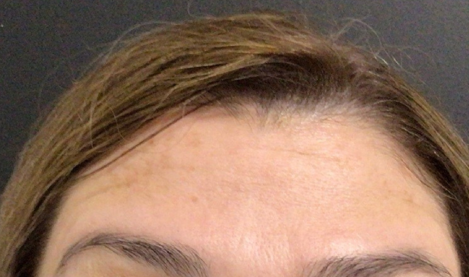 Botox® / Dysport® Case 35 After Image