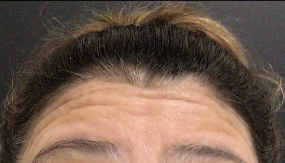 Botox® / Dysport® Case 35 Before Image