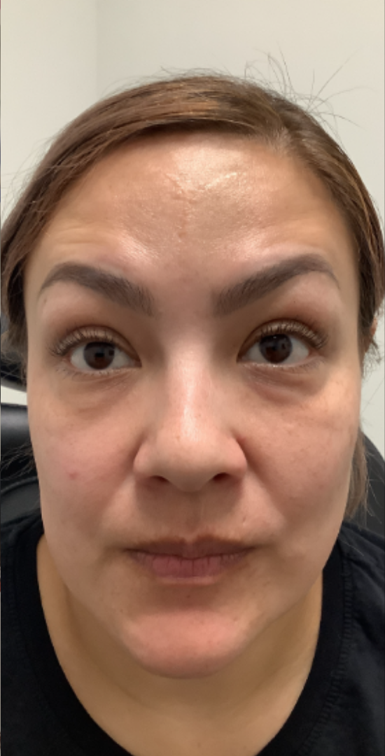 Botox® / Dysport® Case 36 After Image