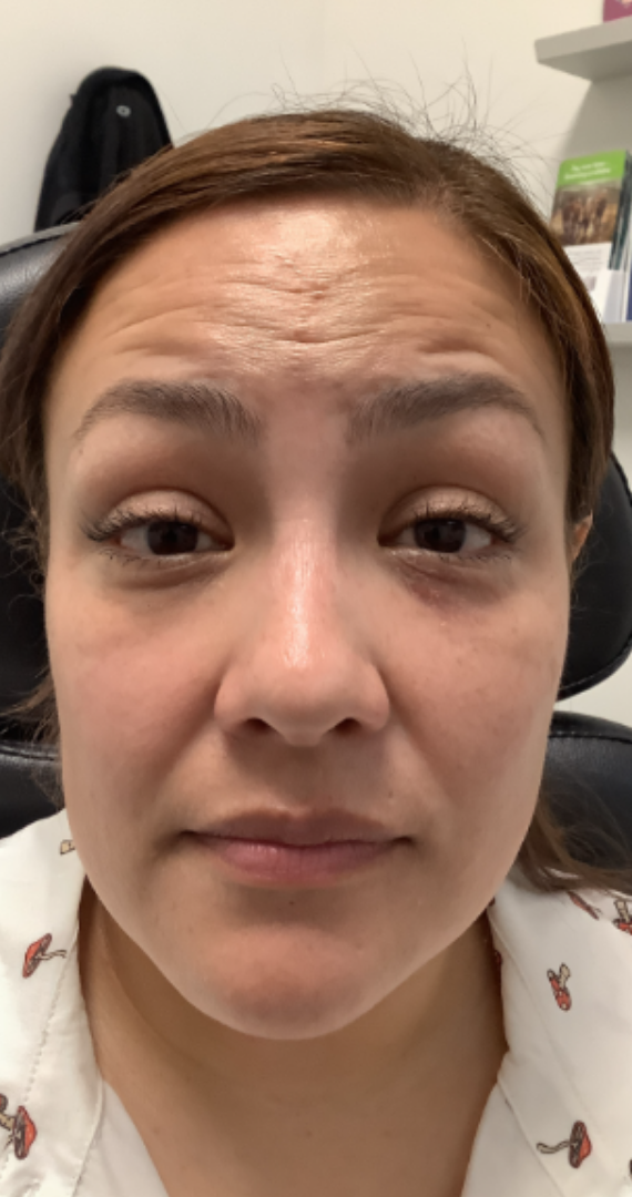 Botox® / Dysport® Case 36 Before Image