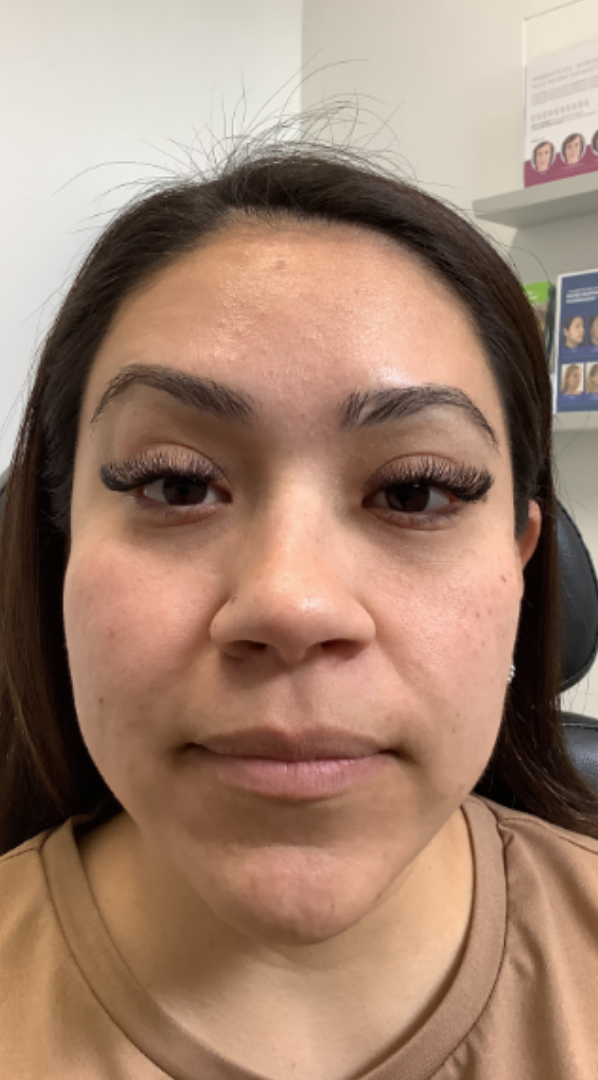 Botox® / Dysport® Case 37 After Image