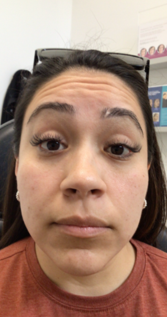 Botox® / Dysport® Case 37 Before Image