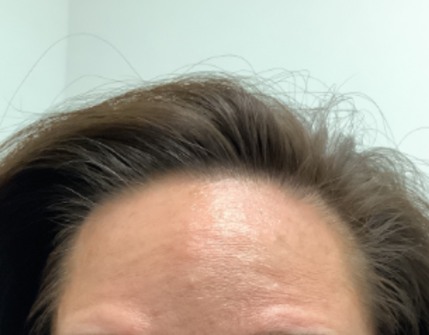 Botox® / Dysport® Case 39 After Image