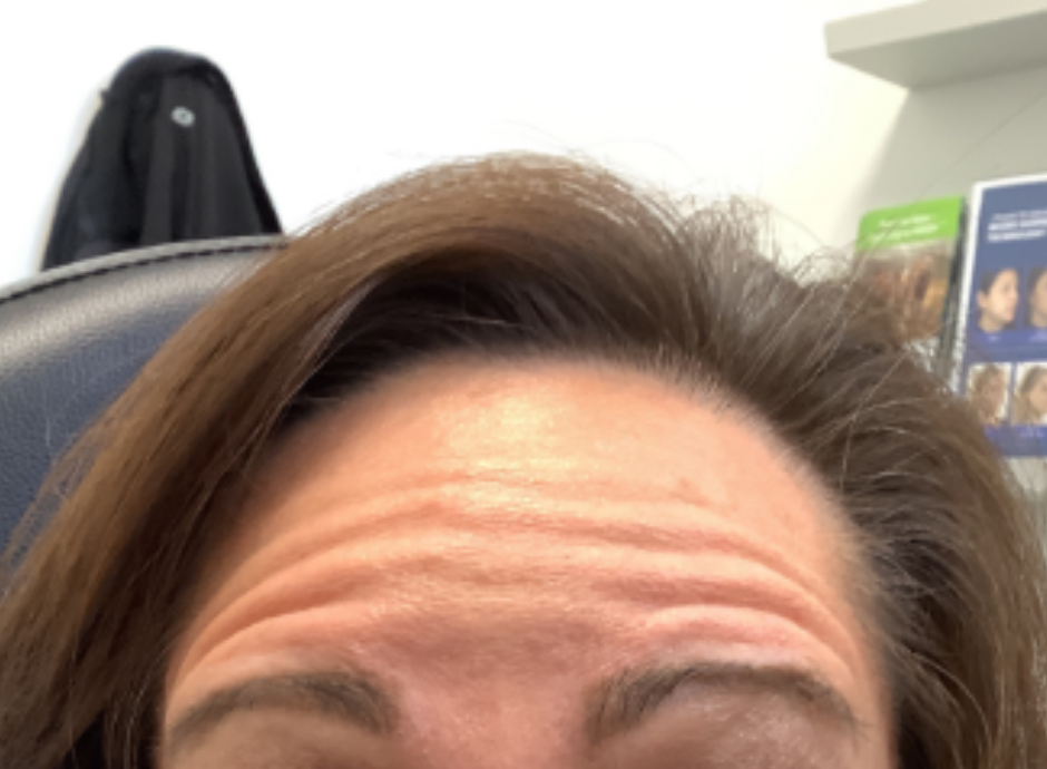 Botox® / Dysport® Case 39 Before Image