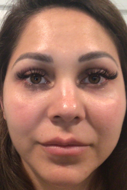 Dermal Fillers Case 47 After Image