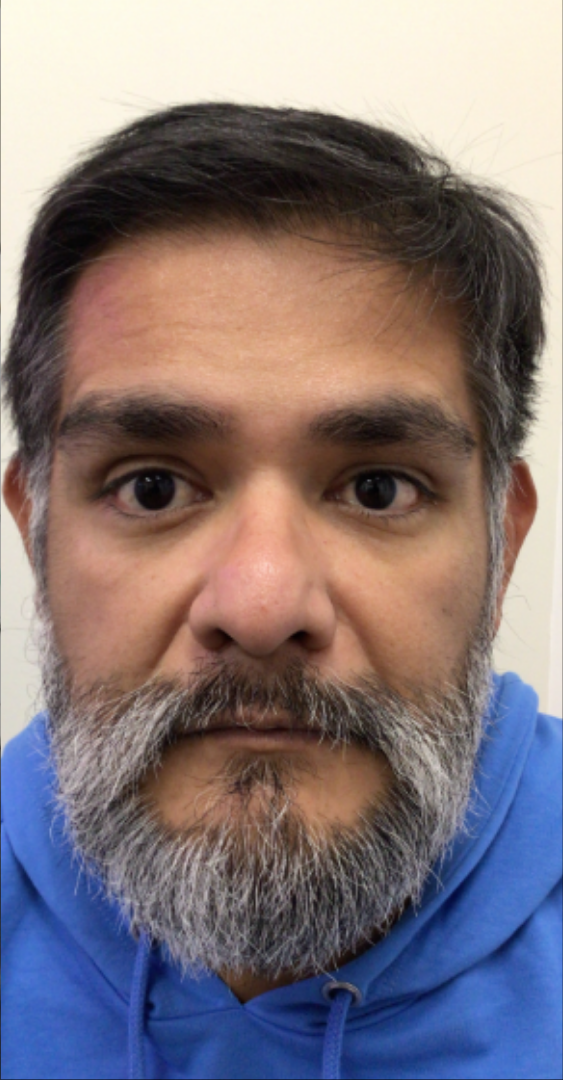 Botox® / Dysport® Case 31 After Image