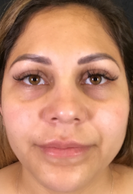 Dermal Fillers Case 47 Before Image