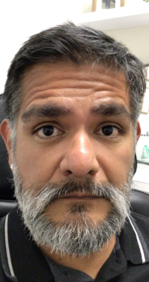Botox® / Dysport® Case 31 Before Image