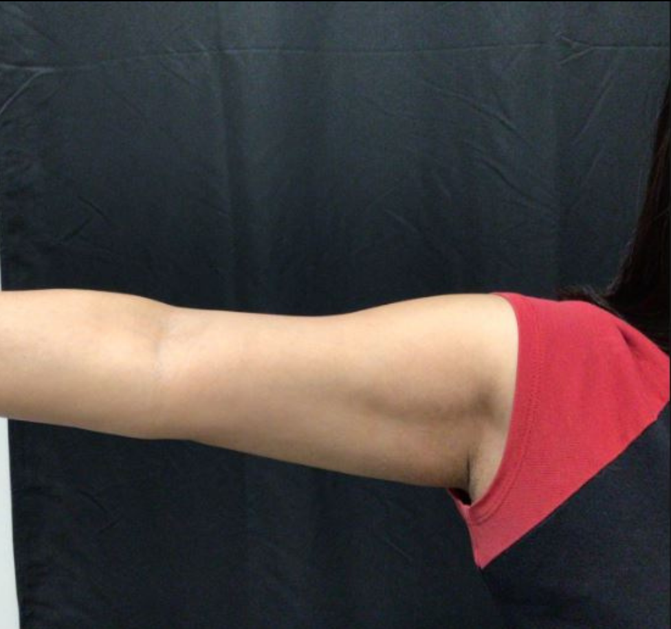 Coolsculpting® ELITE Case 52 After Image