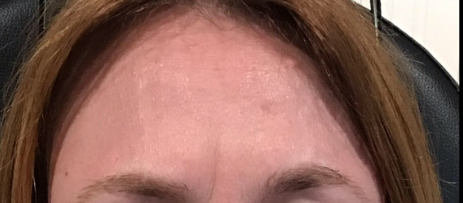 Botox® / Dysport® Case 20 After Image