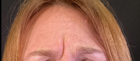 Botox® / Dysport® Case 20 Before Image