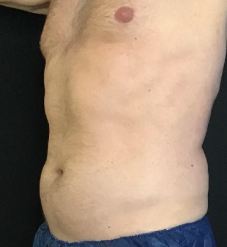 Coolsculpting® ELITE Case 49 After Image