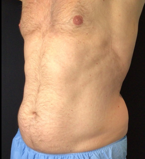 Coolsculpting® ELITE Case 49 Before Image